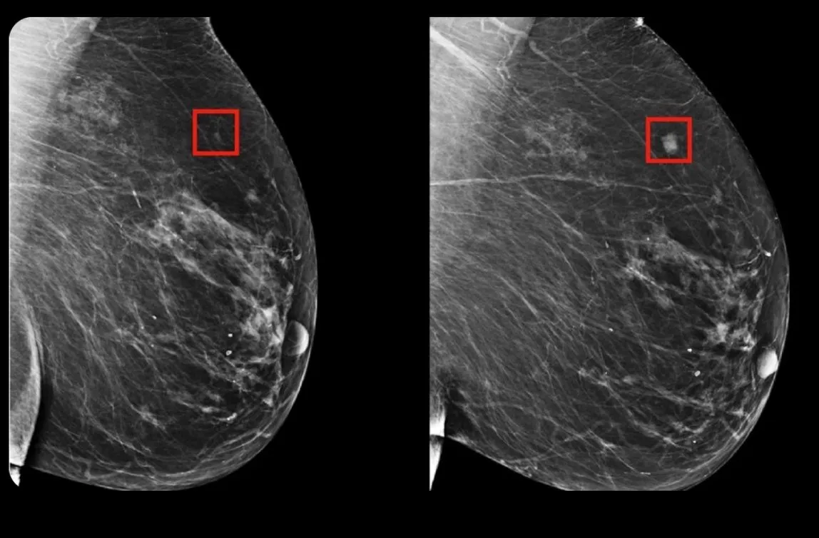 Image: Une IA capable de prédire le risque de cancer du sein 5 ans à l'avance