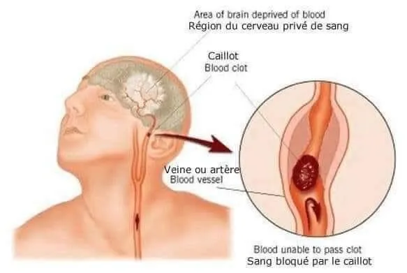 Image: Les signes que vous êtes en train de faire un AVC