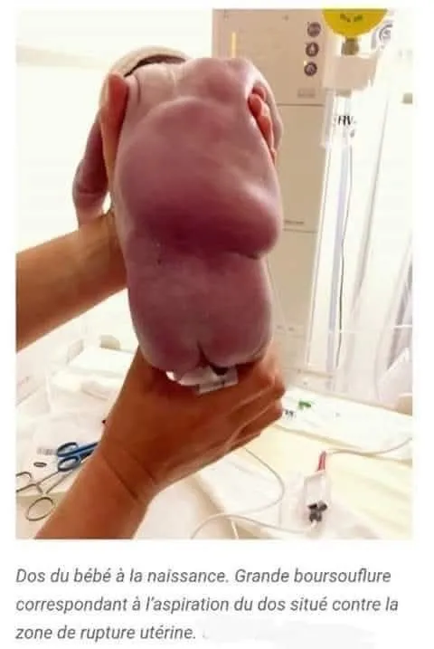 Image: Un foetus sauve sa mère dans son ventre