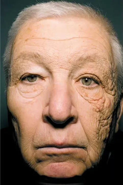 Image: Cet homme a vieilli plus à gauche qu'à droite de son visage.