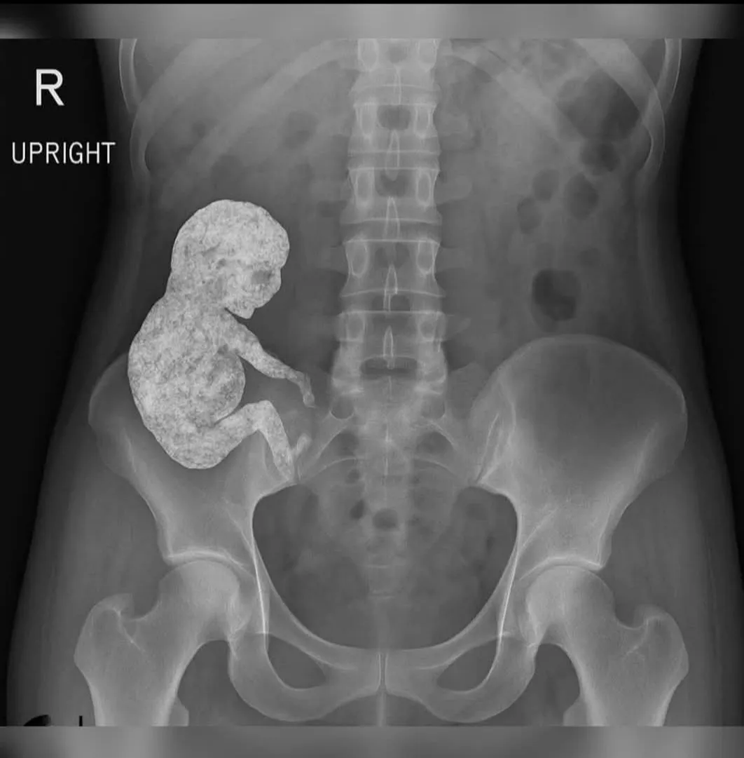 Image: Rosa a gardé un enfant mort dans son corps toute sa vie