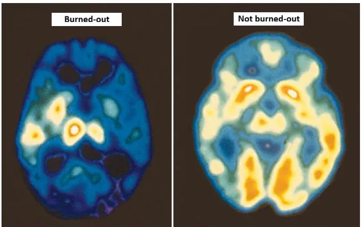 Image: Un burn-out, ça se voit au scanner !