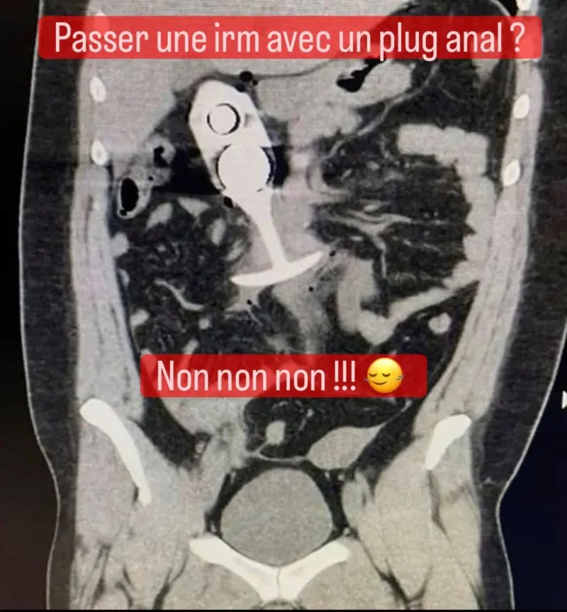 Image: Il est dangereux de passer une IRM avec un plug anal
